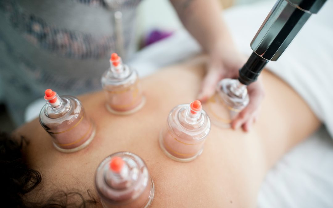 chinese cupping in pain therapy