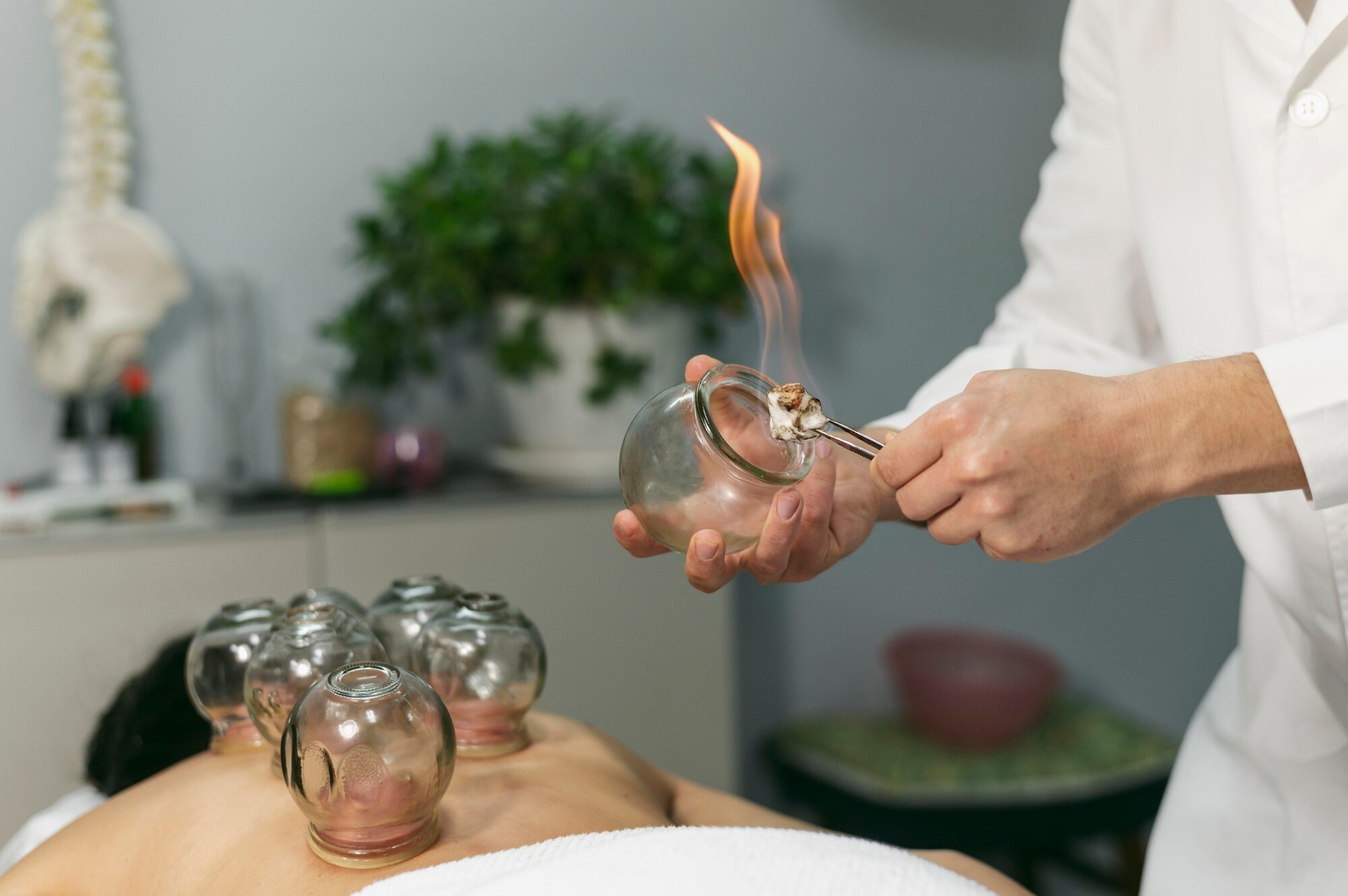 traditional chinese cupping